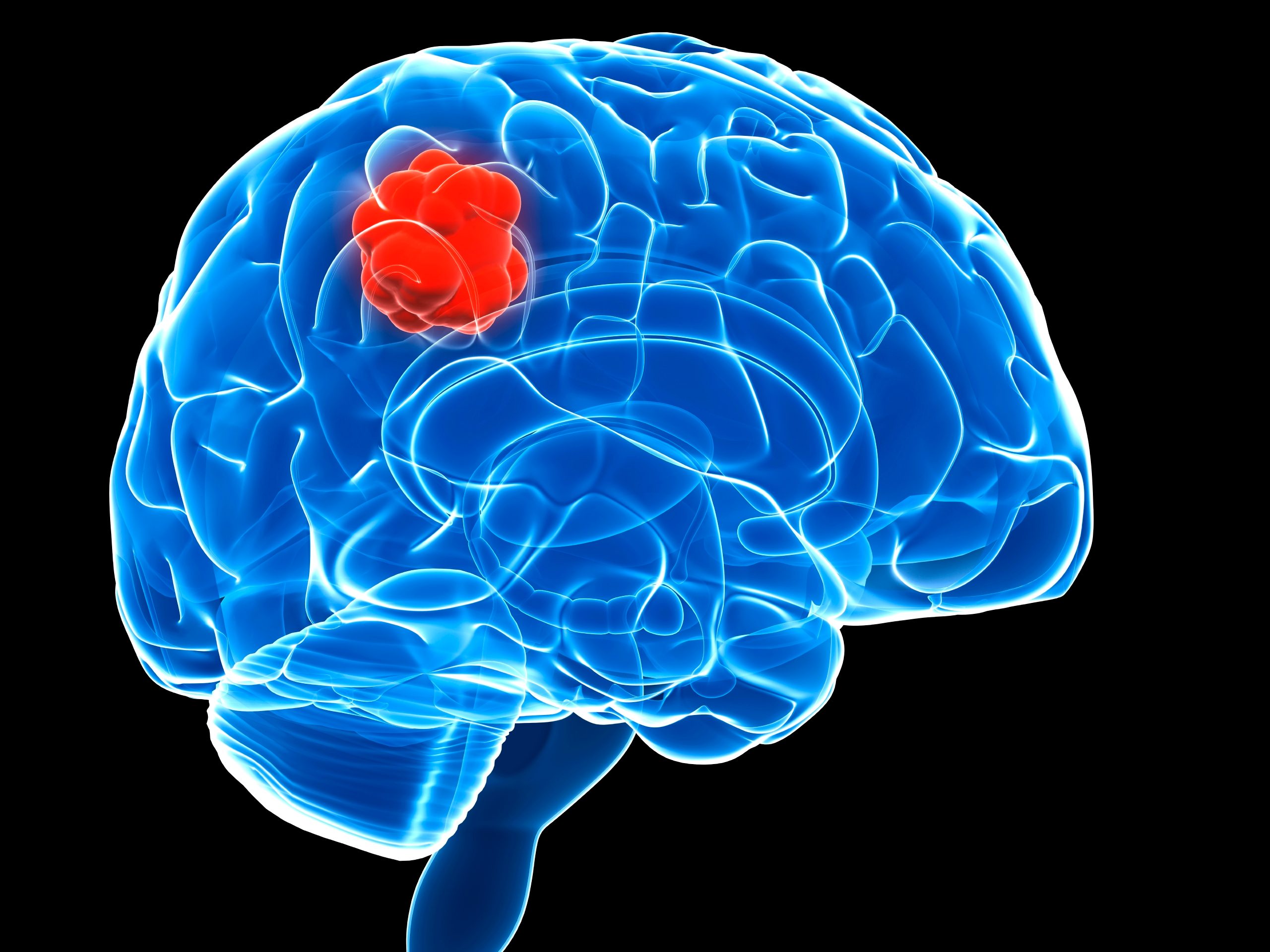 what-is-a-brain-tumor-medicine-for-world