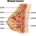 What is Breast Cancer ?