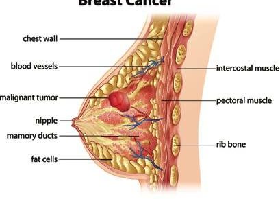What is Breast Cancer ?