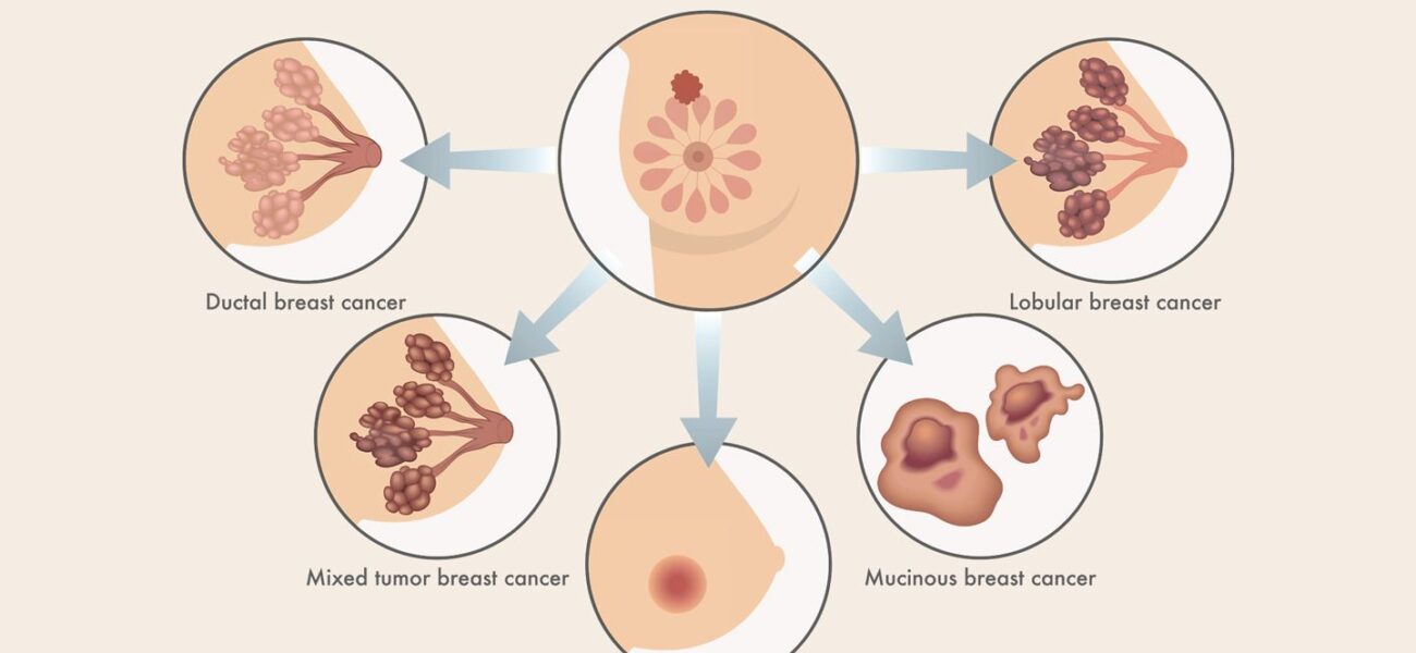 What is Breast Cancer ?