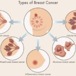 What is Breast Cancer ?