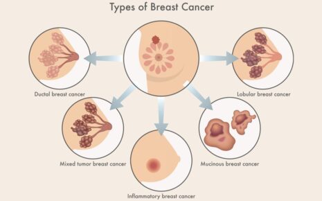 What is Breast Cancer ?