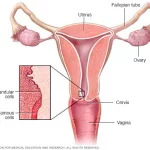 cervical cancer