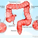 colorectal Cancer