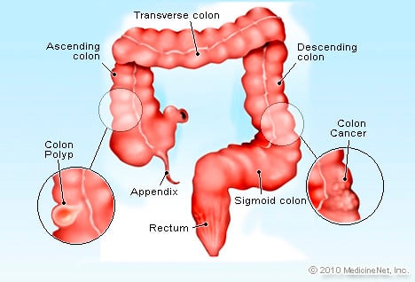 colorectal Cancer