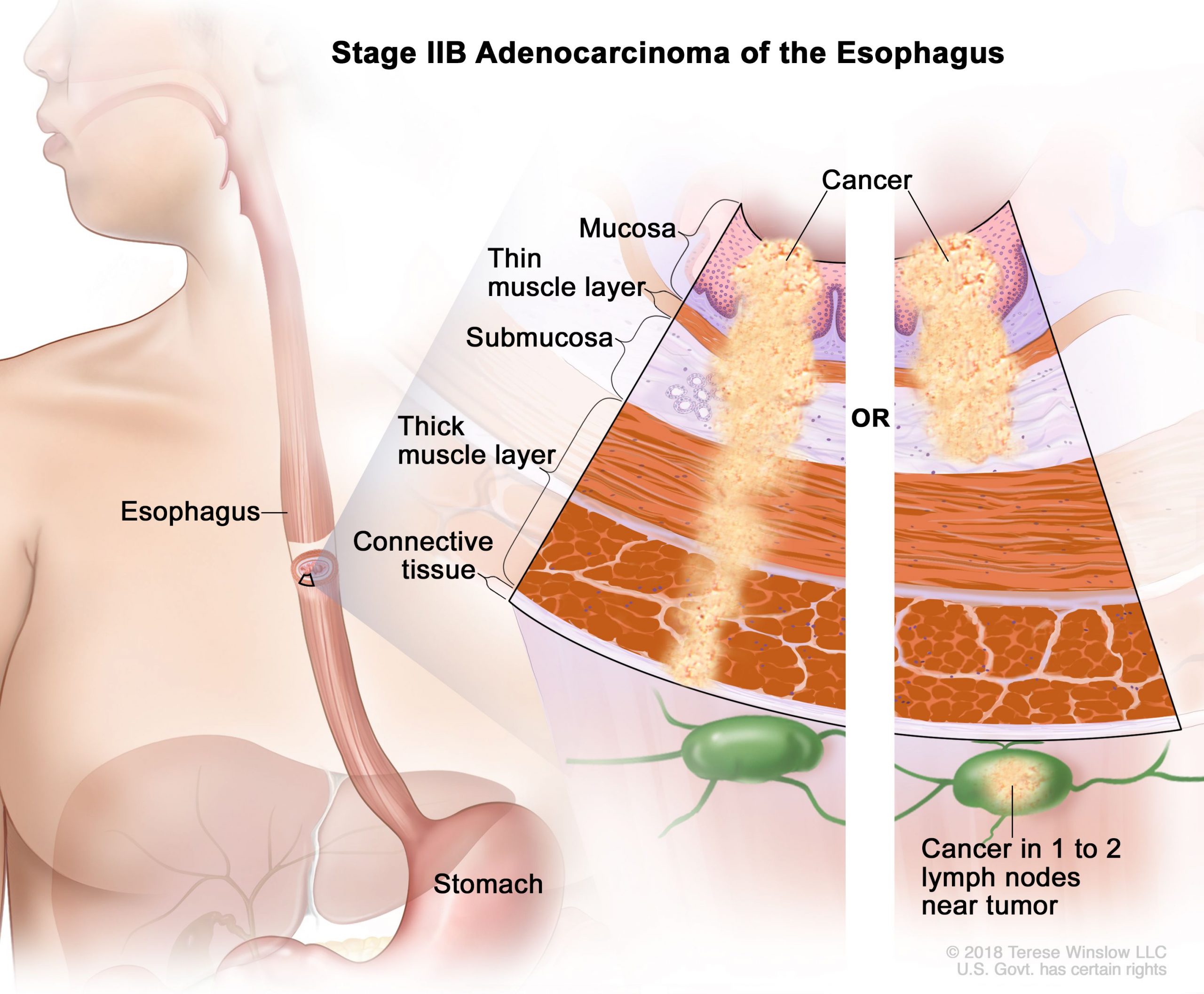 what-is-esophageal-cancer-medicine-for-world-mfw