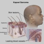 Kaposi Sarcoma