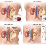 Kidney Cancer