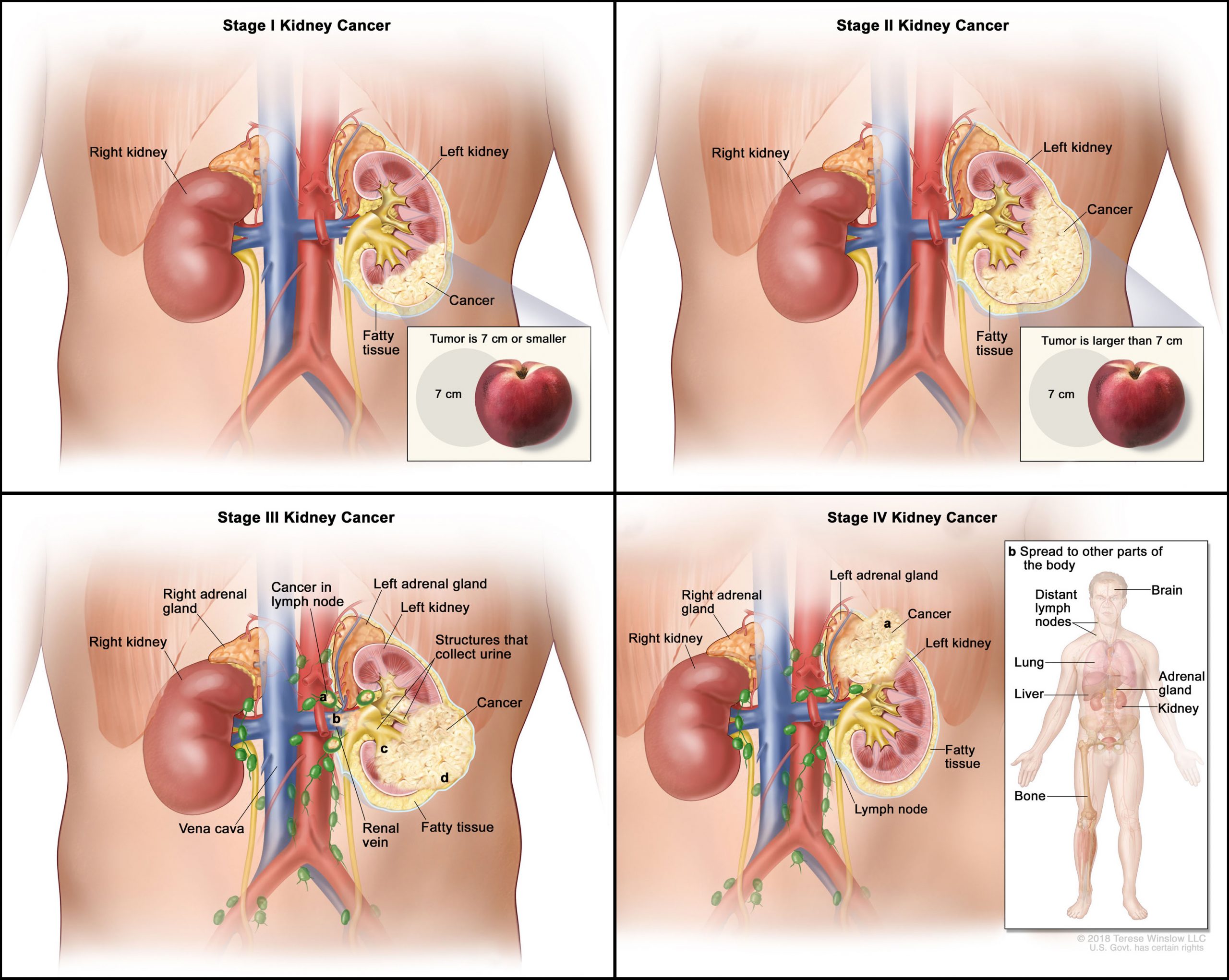 What is Kidney cancer ? MEDICINE FOR WORLD