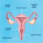 Gynaecological