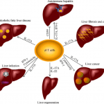 Liver disease