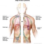 What is Lymphoma ?