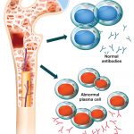 myeloma