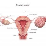 Ovarian cancer