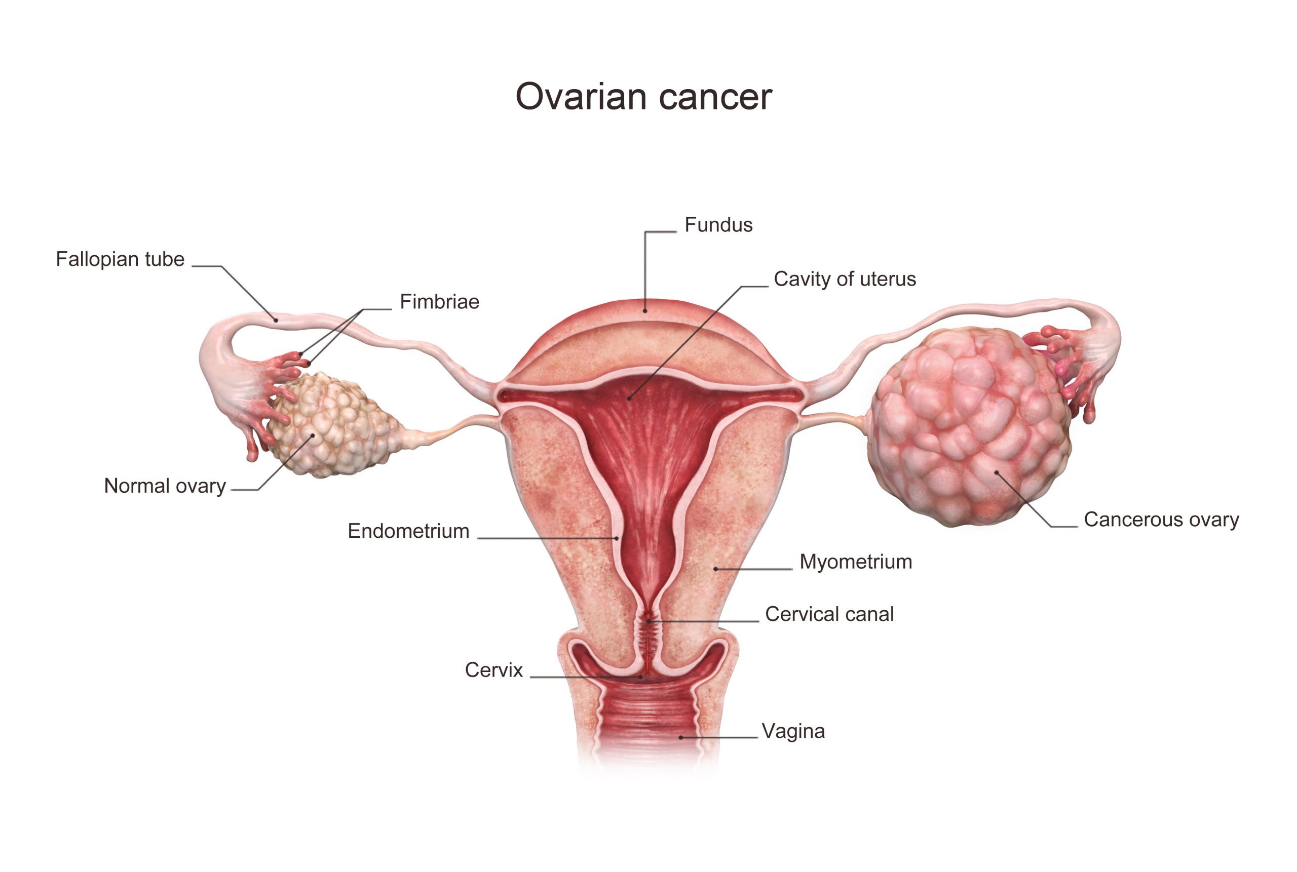 Does Ovarian Cancer Cause Irregular Periods