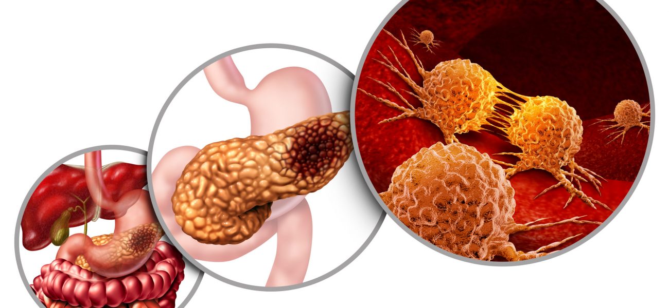 What is Pancreatic Cancer?