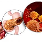 What is Pancreatic Cancer?