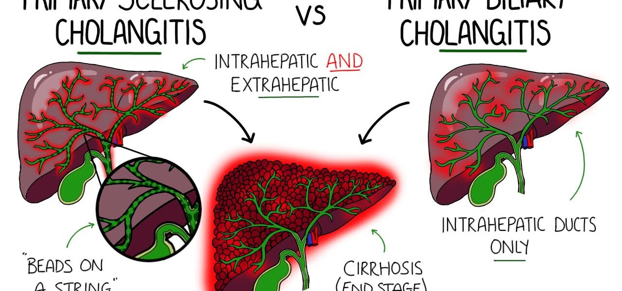 Primary Biliary Cholangitis