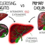 Primary Biliary Cholangitis