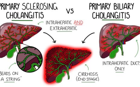 Primary Biliary Cholangitis