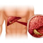 Liver cancer