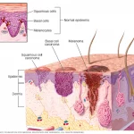 Squamous Cell Cancer