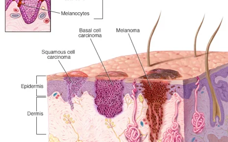 Squamous Cell Cancer