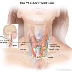 Thyroid cancer