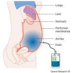Peritoneal Cancers