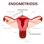 Endometriosis