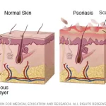 Psoriasis