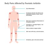 Psoriatic arthritis