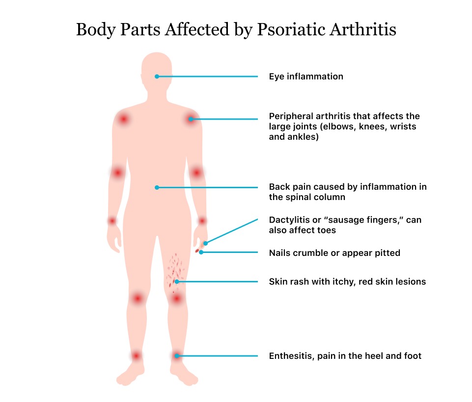 what-is-psoriatic-arthritis-medicine-for-world