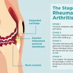 Rheumatoid arthritis