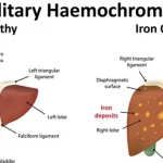 Hemochromatosis