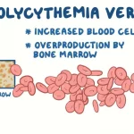 Polycythemia vera