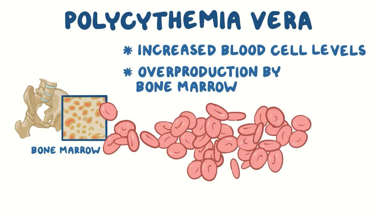 What Is Polycythemia Vera? - MEDICINE FOR WORLD