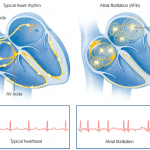 Atrial fibrillation