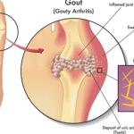 Hyperuricemia