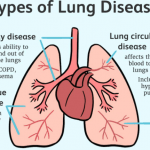 Lung diseases