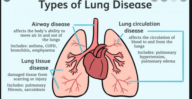 What Is Lung Diseases? - MEDICINE FOR WORLD