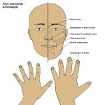 Acromegaly