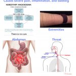 Hereditary Angioedema