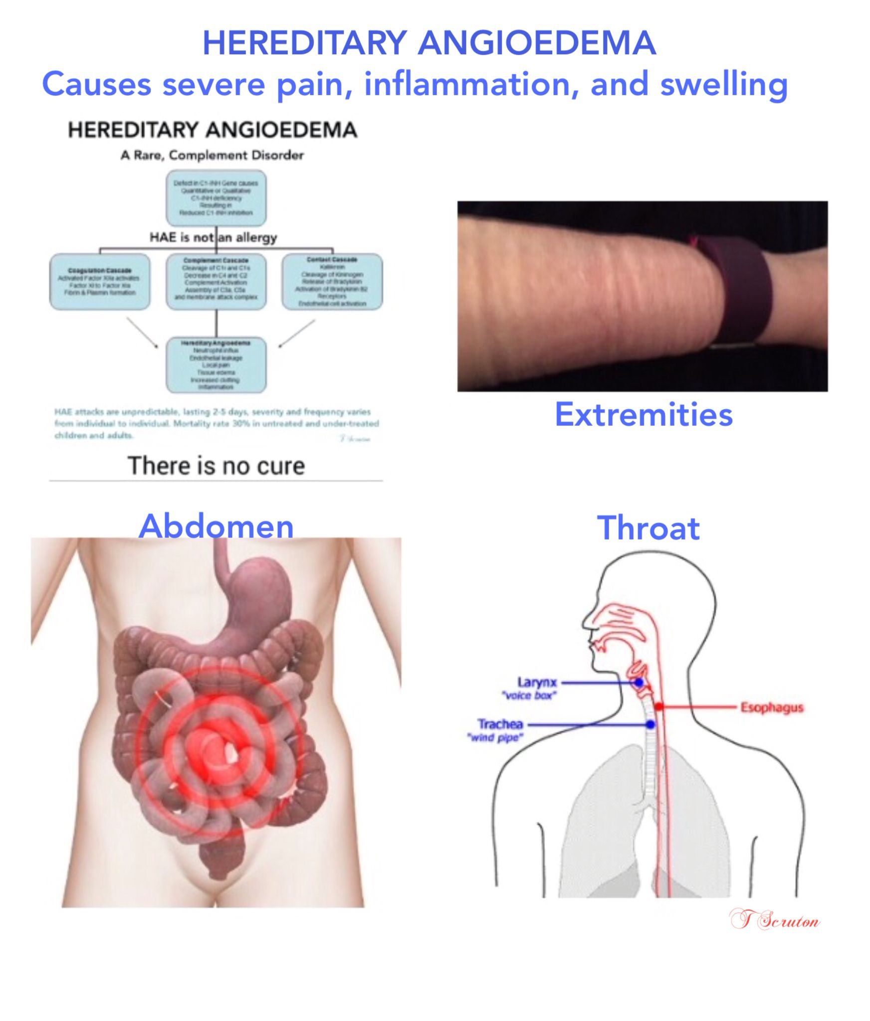 What Is Hereditary Angioedema Medicine For World 