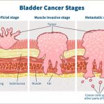 bladder-cancer