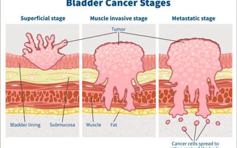 bladder-cancer