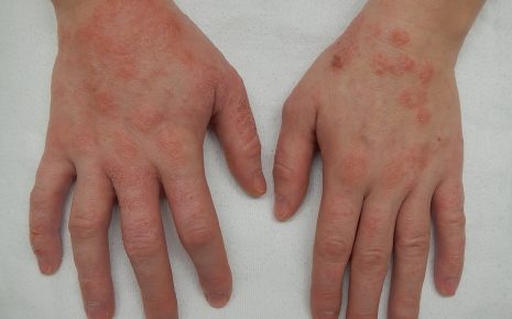 What to know about eczema