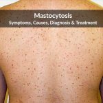 What is mastocytosis?