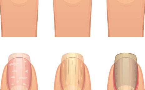 nail changes