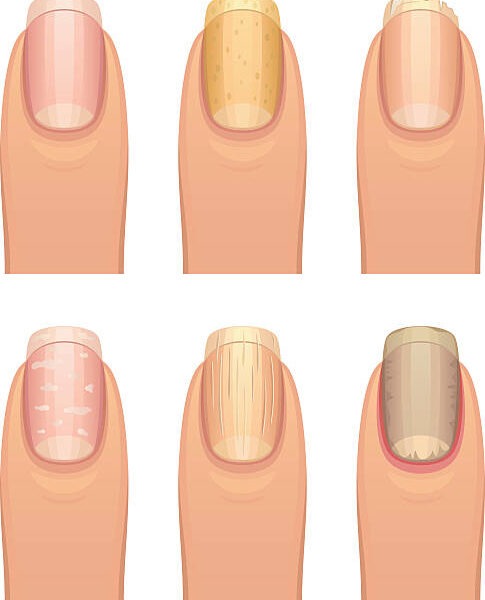 nail changes